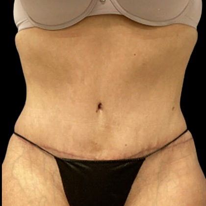 Liposuction Before & After Patient #4646