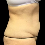 Liposuction Before & After Patient #4646