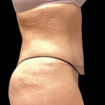 Liposuction Before & After Patient #4646
