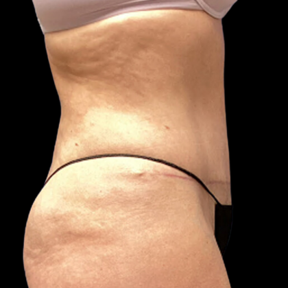 Liposuction Before & After Patient #4646