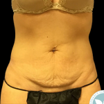 Tummy Tuck Before & After Patient #4342