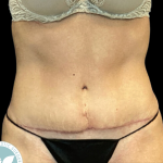 Tummy Tuck Before & After Patient #4342
