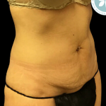 Tummy Tuck Before & After Patient #4342