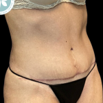 Tummy Tuck Before & After Patient #4342