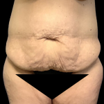 Tummy Tuck Before & After Patient #4343