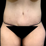 Tummy Tuck Before & After Patient #4343