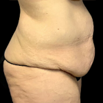 Tummy Tuck Before & After Patient #4343