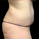 Tummy Tuck Before & After Patient #4343