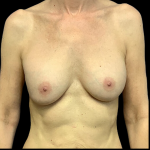 Implant Removal Before & After Patient #4347