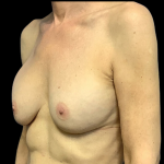 Implant Removal Before & After Patient #4347