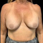 Implant Removal Before & After Patient #4348
