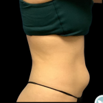 Liposuction Before & After Patient #4350