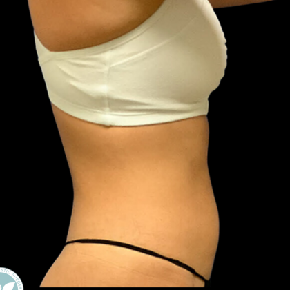 Liposuction Before & After Patient #4350