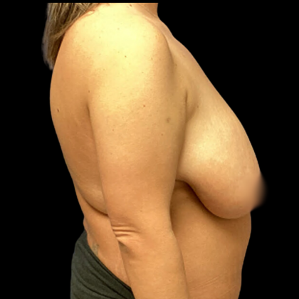 Breast Augmentation Before & After Patient #4351