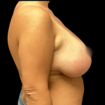 Breast Augmentation Before & After Patient #4351