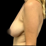 Breast Lift Before & After Patient #4352