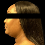 Neck Lift Before & After Patient #4354