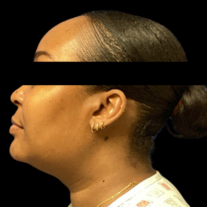 Neck Lift Before & After Patient #4354
