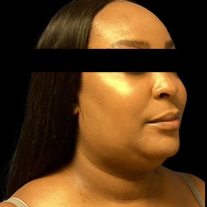 Neck Lift Before & After Patient #4354