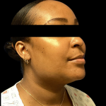 Neck Lift Before & After Patient #4354