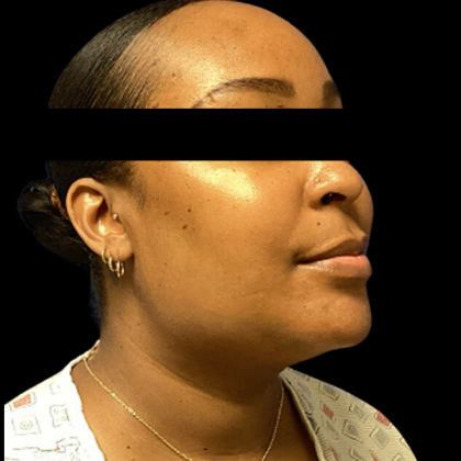 Neck Lift Before & After Patient #4354