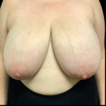 Breast Reduction Before & After Patient #4357