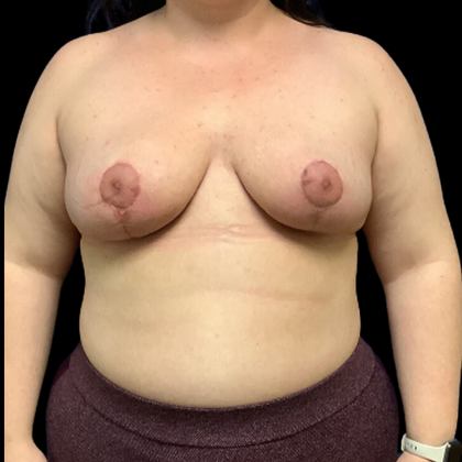 Breast Reduction Before & After Patient #4358
