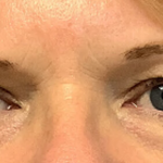 Blepharoplasty Before & After Patient #4449