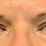 Blepharoplasty Before & After Patient #4449