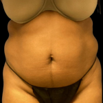 Liposuction Before & After Patient #4362