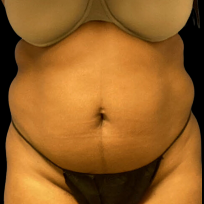 Liposuction Before & After Patient #4362