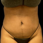 Liposuction Before & After Patient #4362