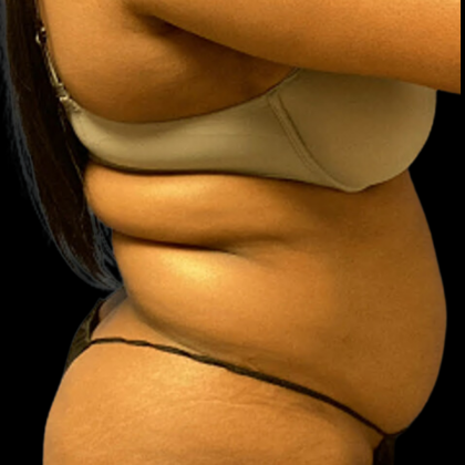 Liposuction Before & After Patient #4362