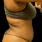 Liposuction Before & After Patient #4362