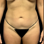 Liposuction Before & After Patient #4363