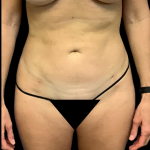 Liposuction Before & After Patient #4363