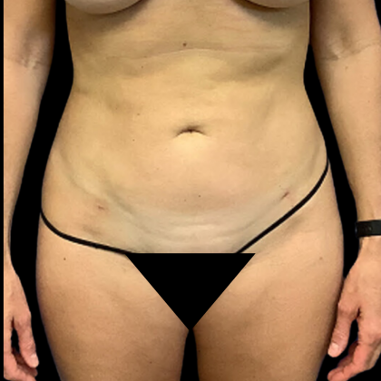 Liposuction Before & After Patient #4363