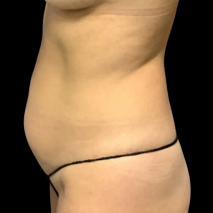 Liposuction Before & After Patient #4363