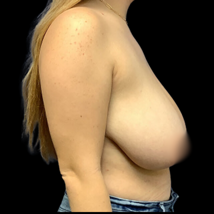Breast Reduction Before & After Patient #4364