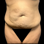 Liposuction Before & After Patient #4644