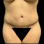 Liposuction Before & After Patient #4644