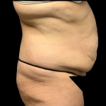 Liposuction Before & After Patient #4644