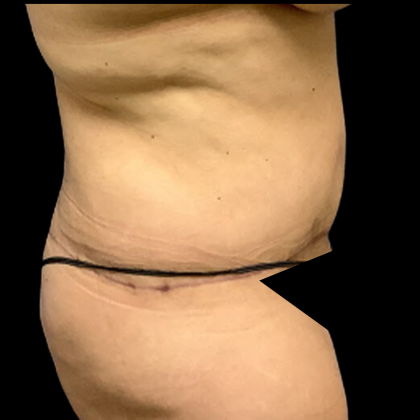 Liposuction Before & After Patient #4644