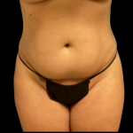 Tummy Tuck Before & After Patient #4324