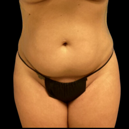 Tummy Tuck Before & After Patient #4324