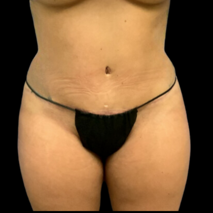 Tummy Tuck Before & After Patient #4324