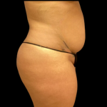 Tummy Tuck Before & After Patient #4324