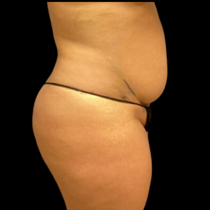 Tummy Tuck Before & After Patient #4324