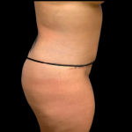 Tummy Tuck Before & After Patient #4324