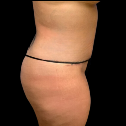 Tummy Tuck Before & After Patient #4324